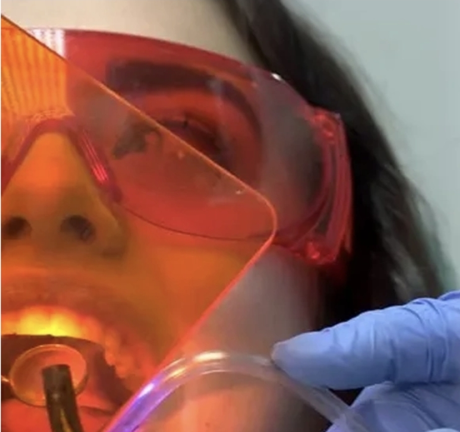 شیلد دستگاه لایت کیور